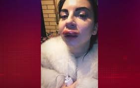 Дівчина хотіла збільшити губи, а тепер боїться, що вони луснуть (відео)