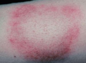 У сусідній із Закарпаттям області у 21 мешканця діагностували небезпечну хворобу