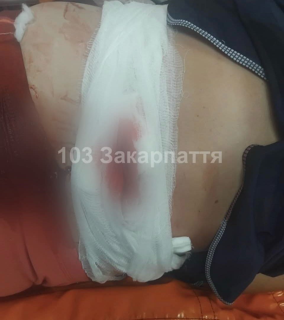 ​На Мукачівщині жінка впала на склянку зі сходів: 10-сантиметровий уламок застряг у спині